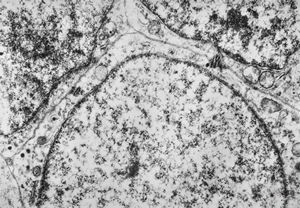 M,5y. | retroperitoneal neuroblastoma - metastasis to neck